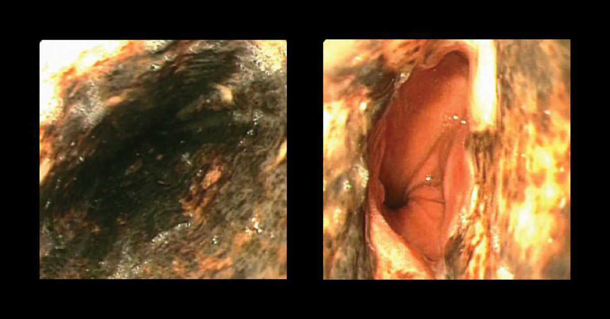 What Is The Diagnosis For Acute Onset Of Vomiting
