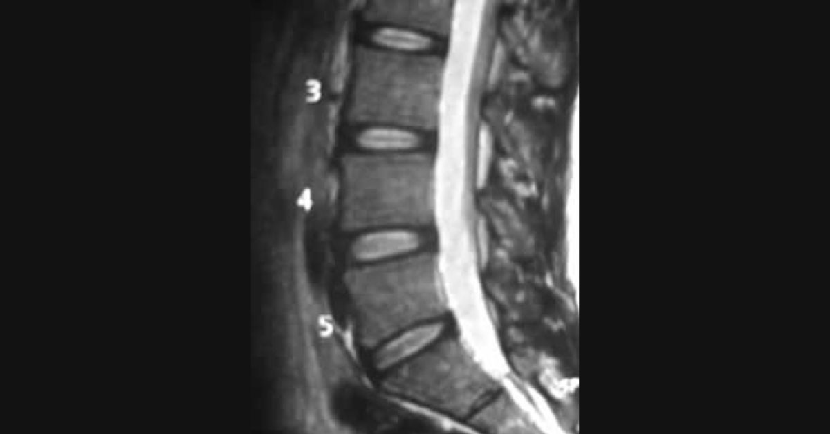 Old Lady With Pain And Paralysis Of Left Lower Limb