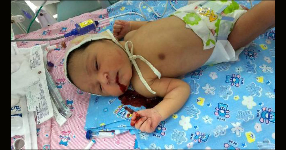 Hematemesis In Neonate 