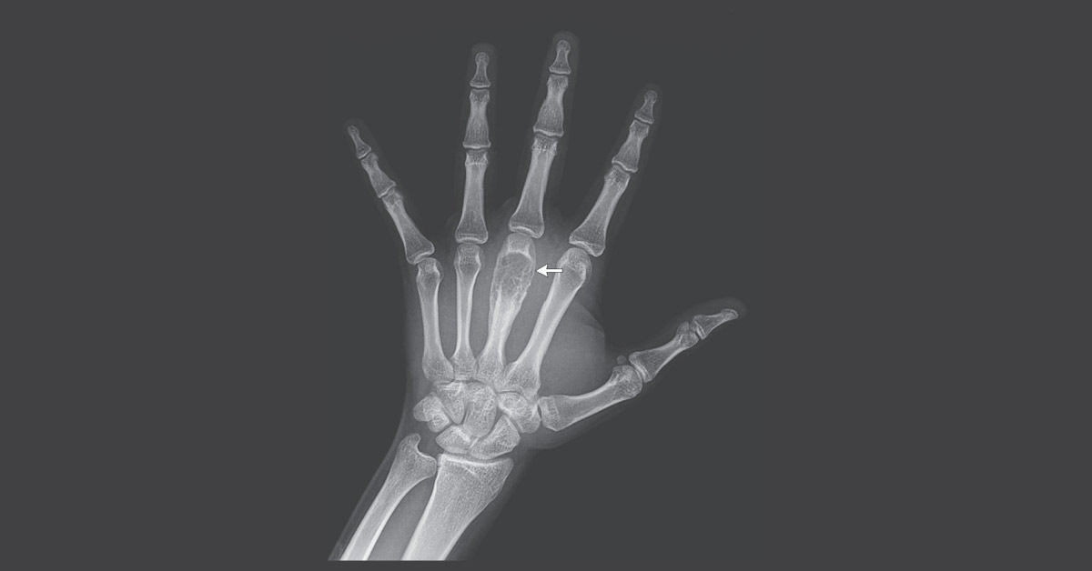 Identify This Rare Skeletal Disorder