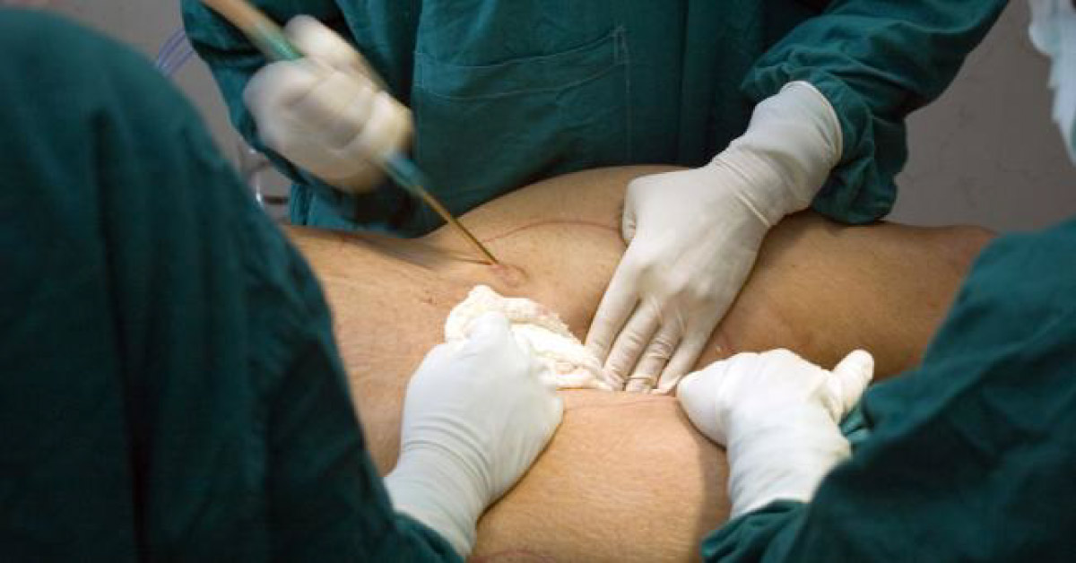 Role Of Vagotomy In Bariatric Surgery.  May Be Compulsory