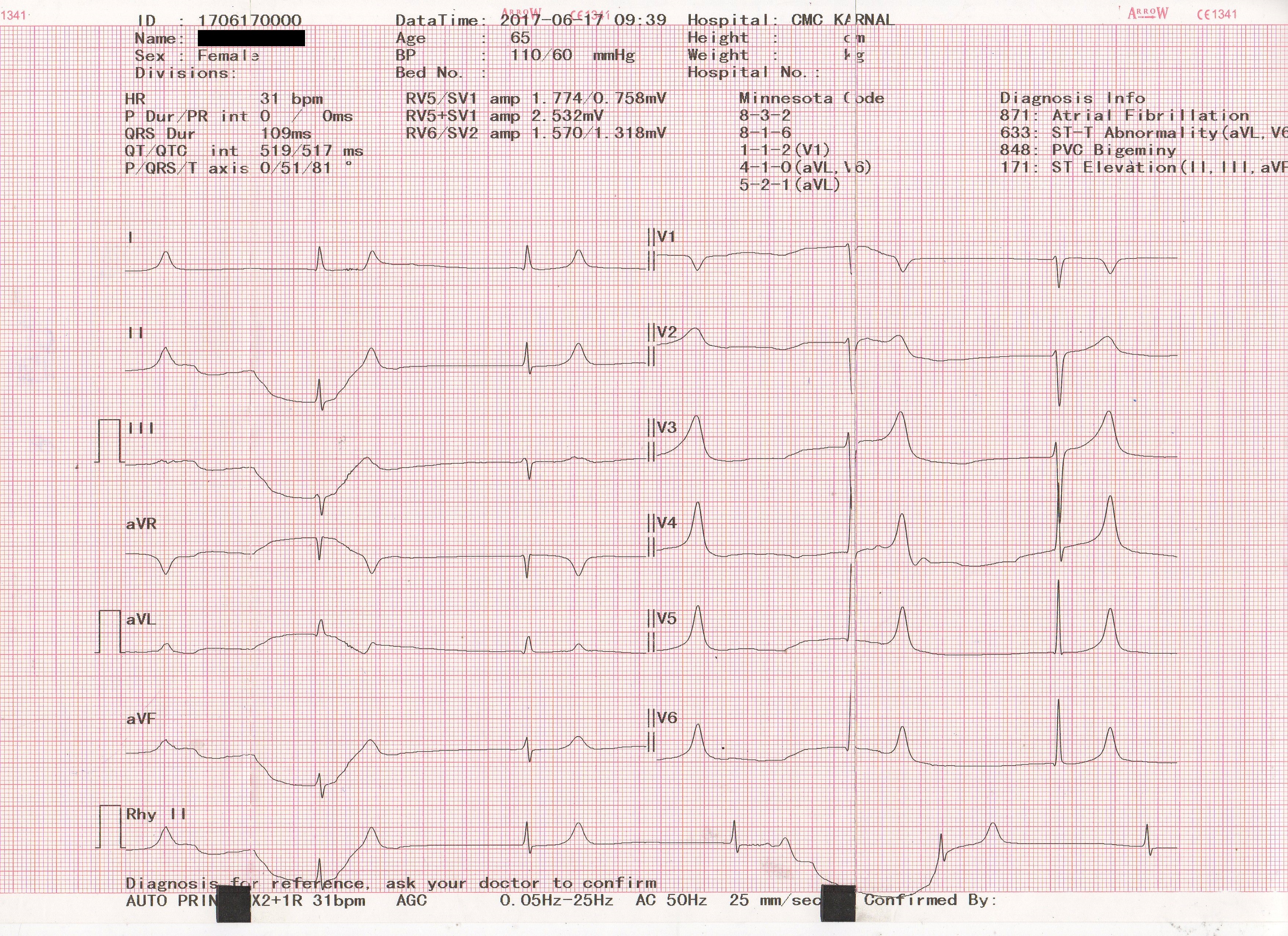 Spot The ECG Of Old Lady