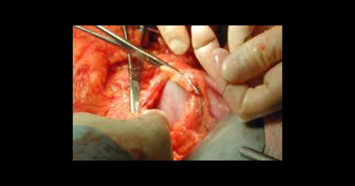 Palliative Gastrectomy Vs Anterior Gastrojejunostomy