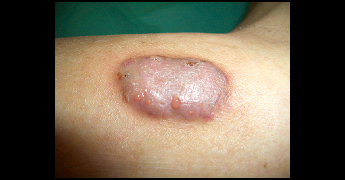 Dermatology Case For Diagnosis