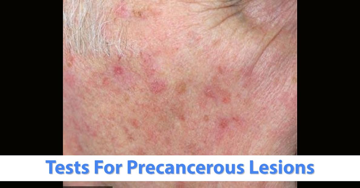 Diagnostic Tests For Precancerous Lesions