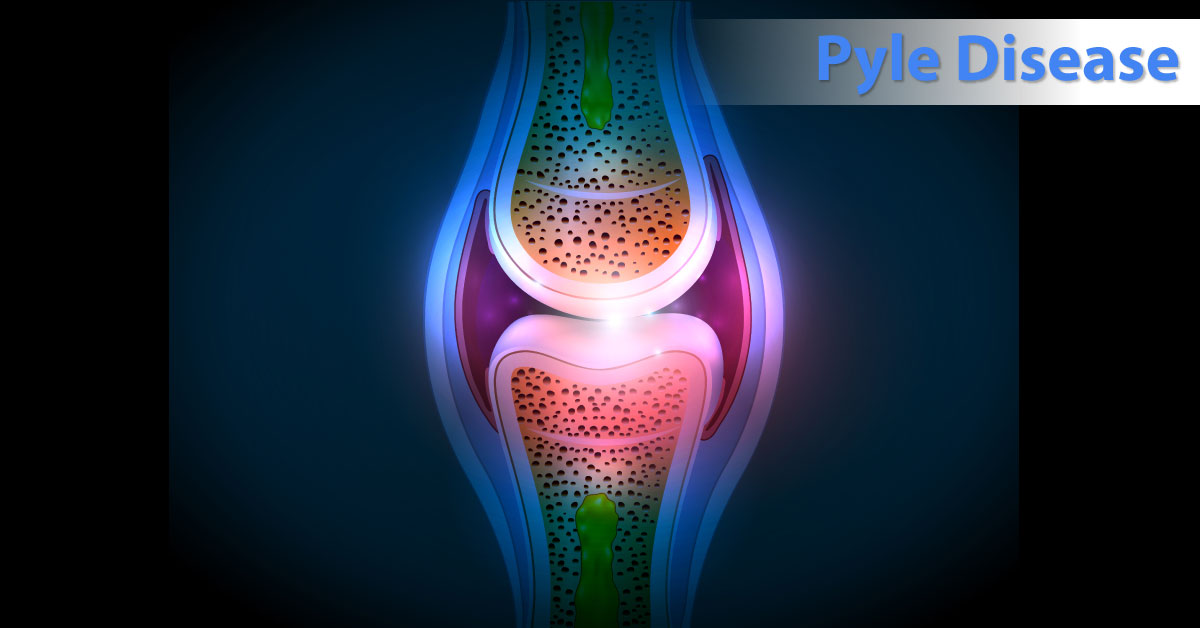 Pyle Disease, A Rare Genetic Bone Disorder
