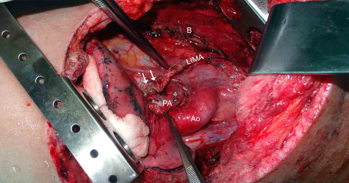 Reinforcement Of The Bronchial Stump With A Pedicled LIMA After Lung Resection