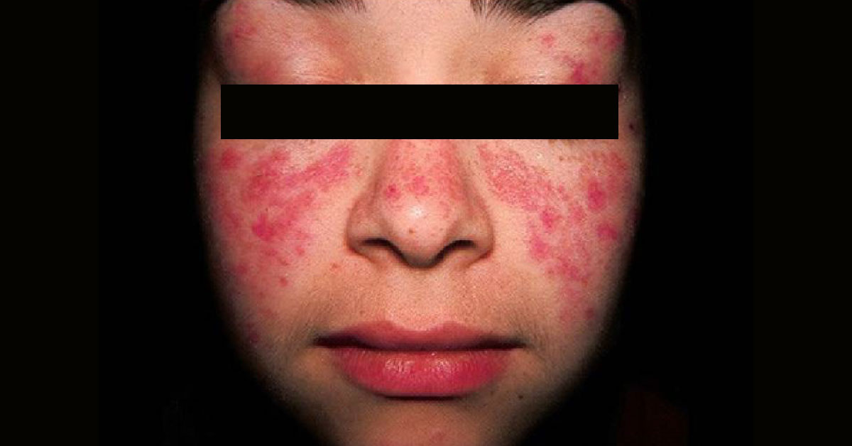 Diagnose The Skin Condition