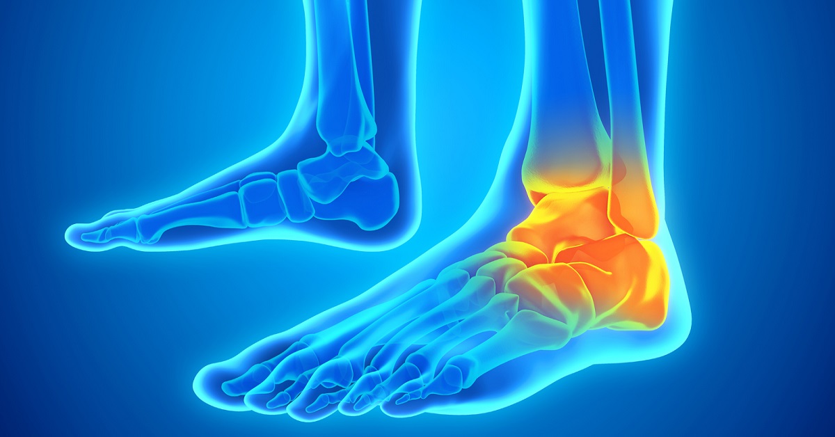 Case Of Torn Ligament In Ankle Sprain