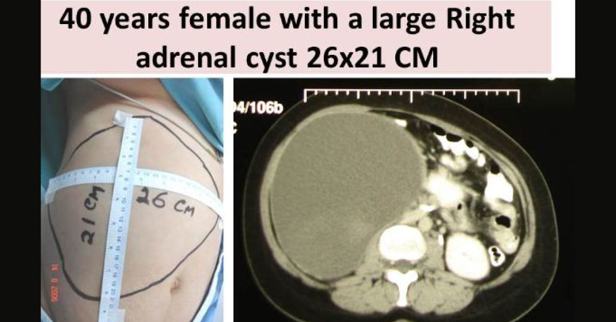 Control Of Sudden Per Operative Torrential Hemorrhage