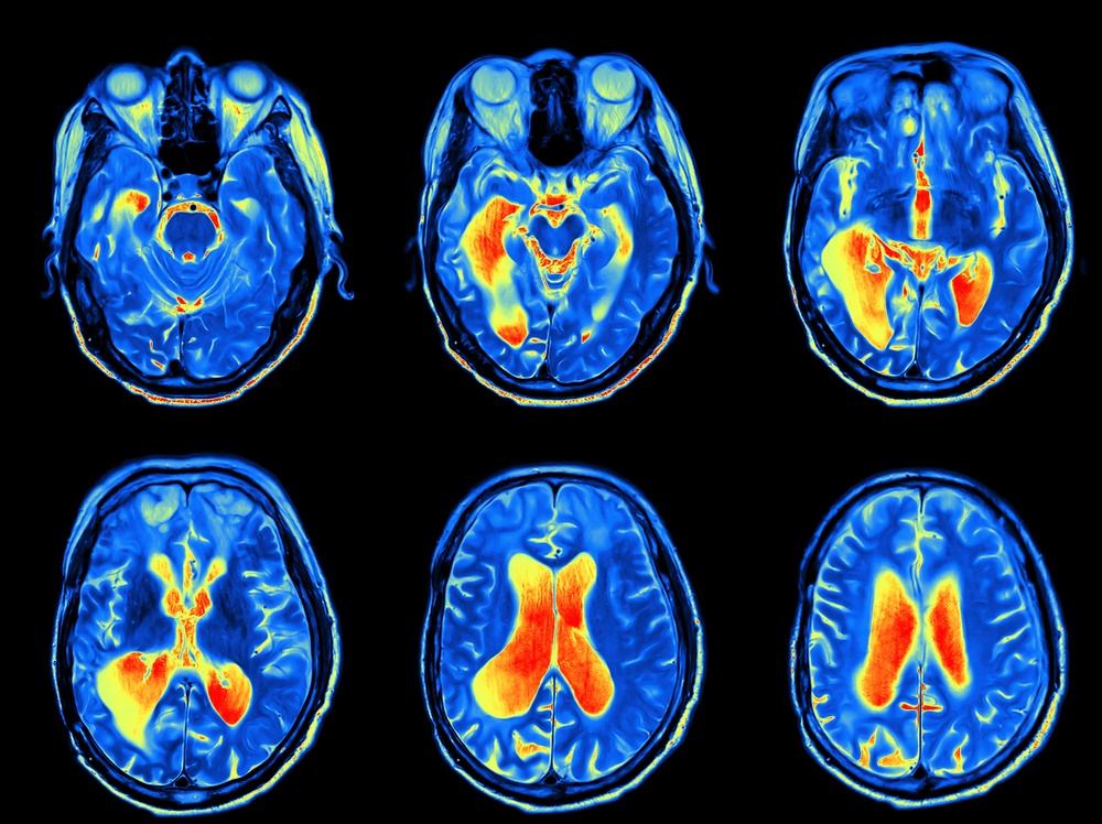 Intraoperative MRI in Pediatric Neurosurgery