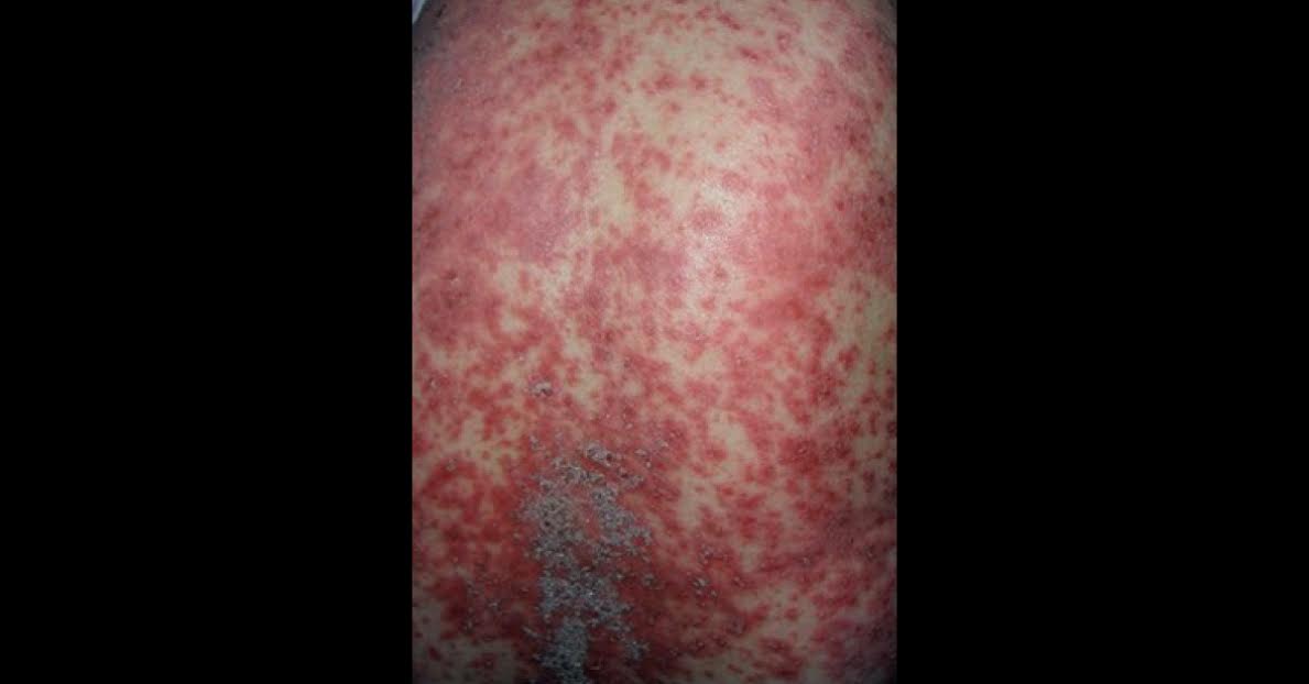 Diagnosis For Itchy Papules