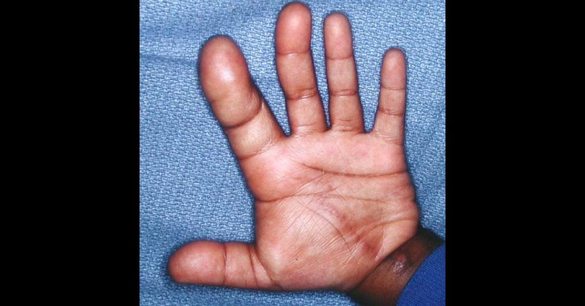 Macrodactyly, A Rare Condition