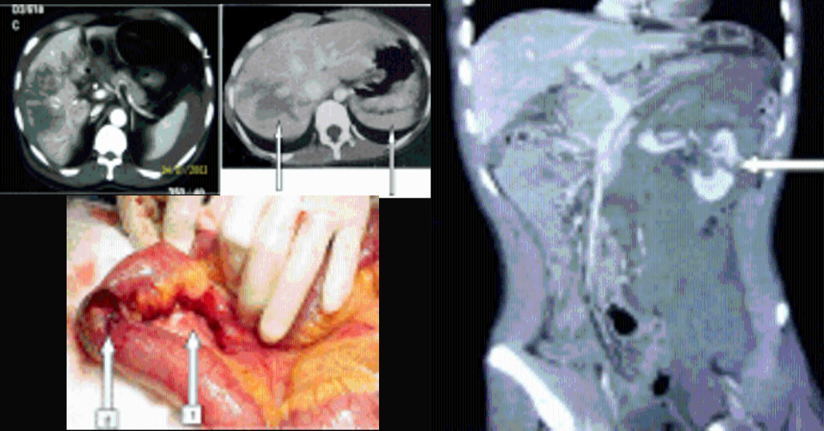 Non Operative Management Of Abdominal Trauma