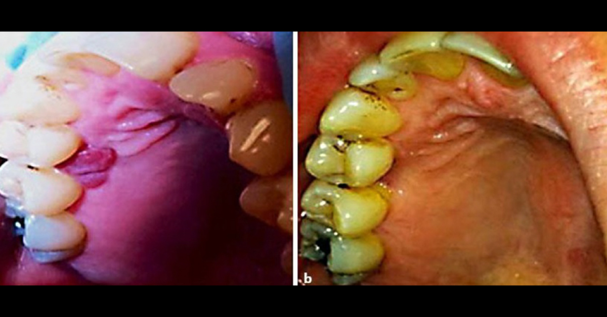Suggest Alternative Treatment For Recurrent Pyogenic Granuloma