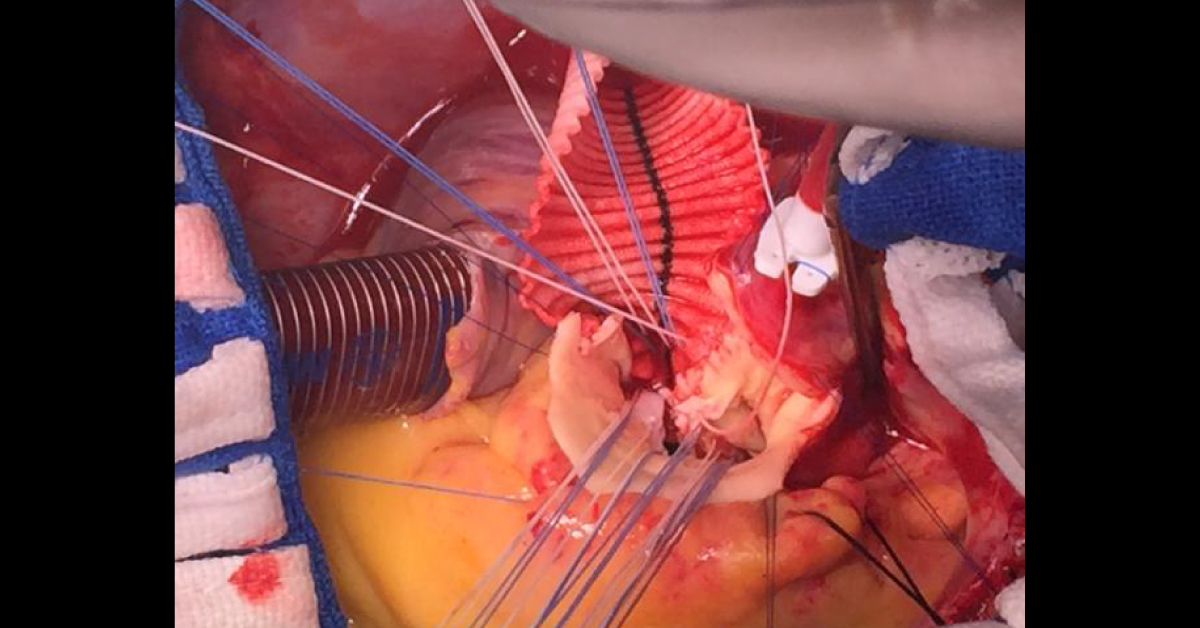 Aortic Root Enlargement