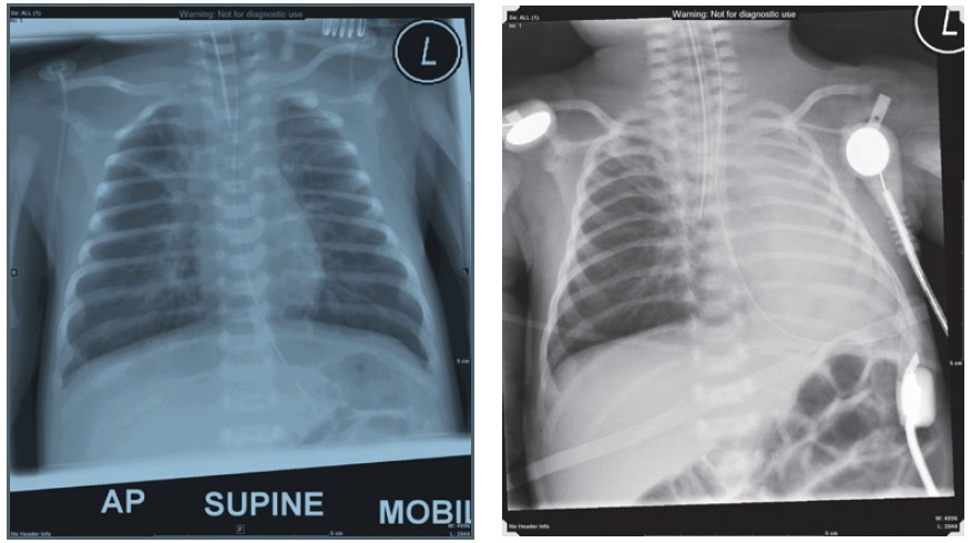 Infant With Progressive Cough