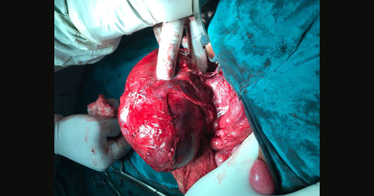 Wilm's Tumour Right Sided