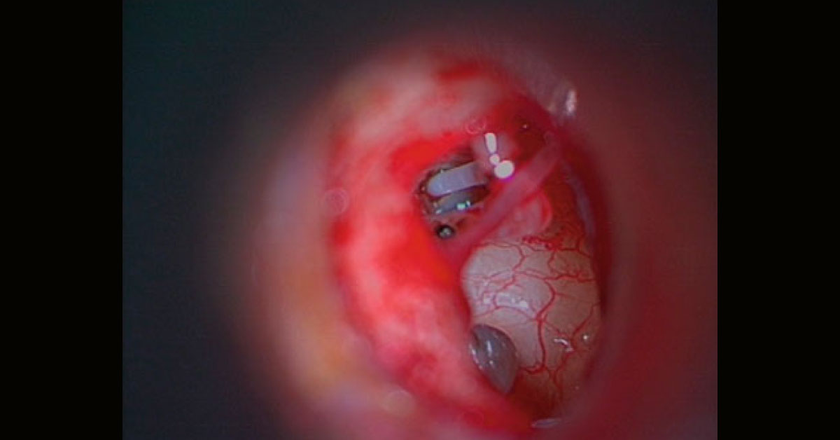 Treatment Of Choice For Otosclerosis