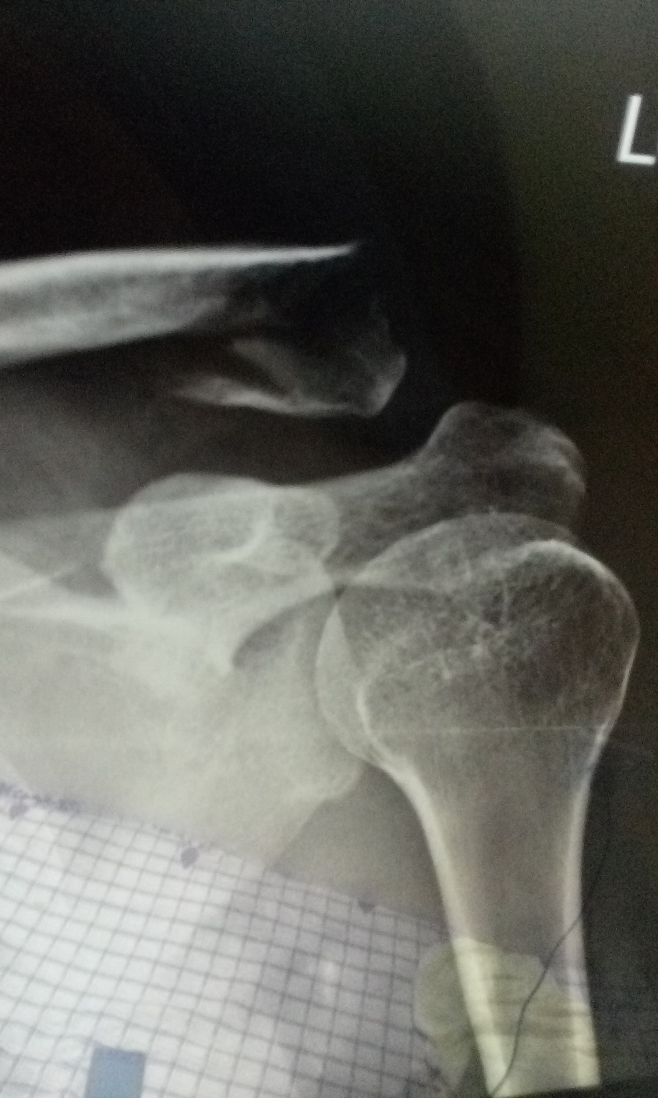 Fracture Lateral Third Of Left Clavicle