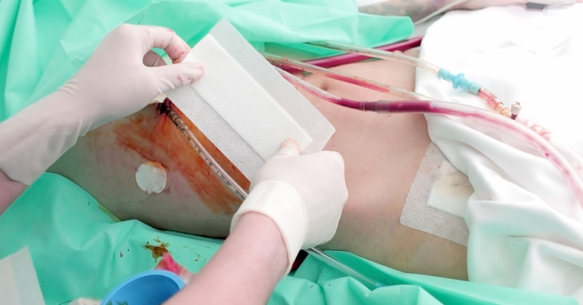 Hepatitis C Infection In Kidney Transplantation