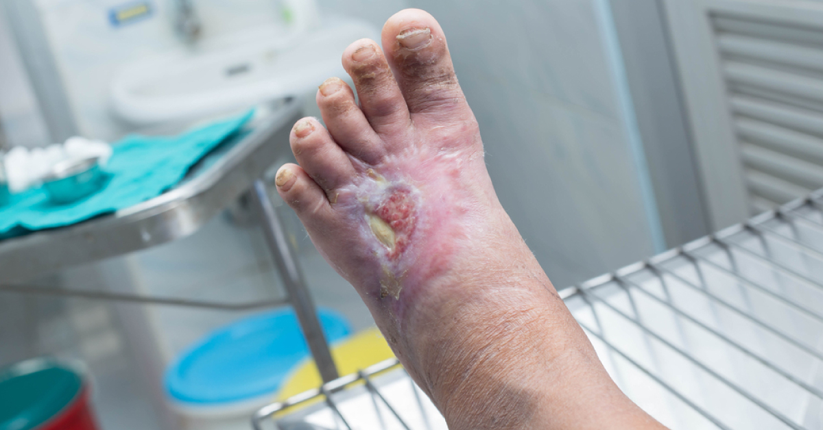 Diabetic Foot Treatment, Five Pronged Attack
