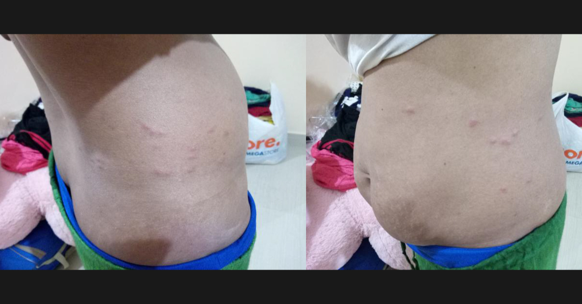 Diagnose The Lesions On Lower Abdomen