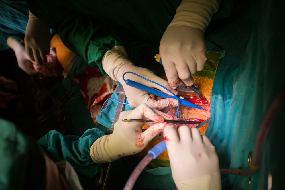 Role Of Collaterals, Natural CABG