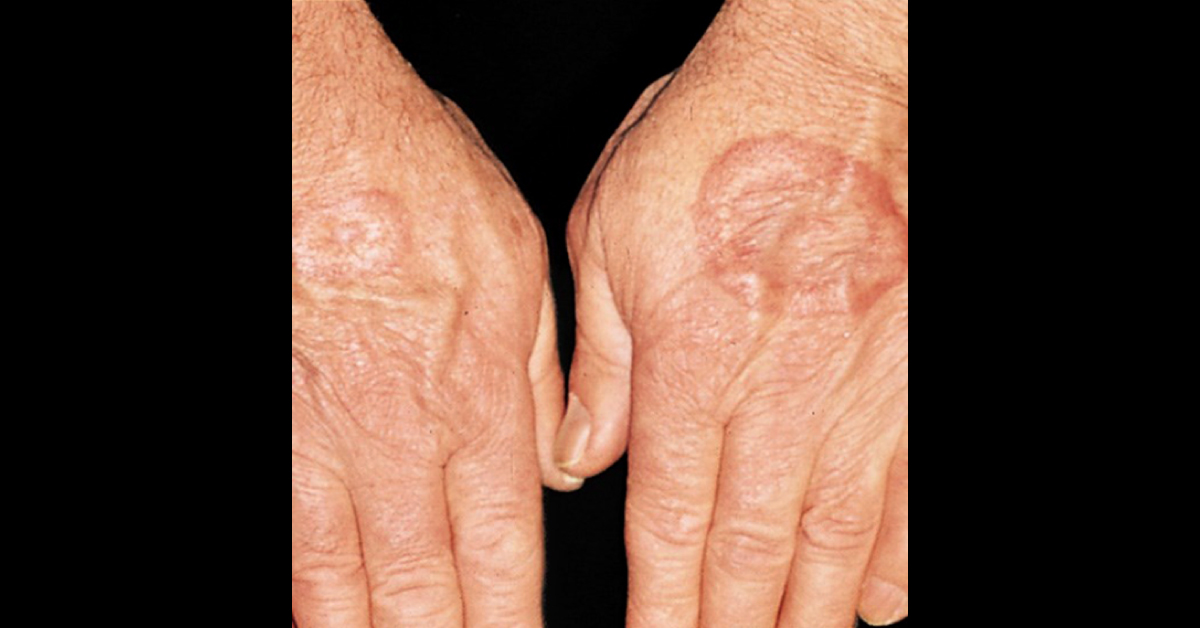Annular Eruption On The Hands