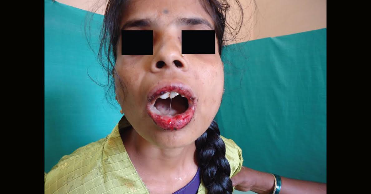 Diagnosis For Skin Lesions