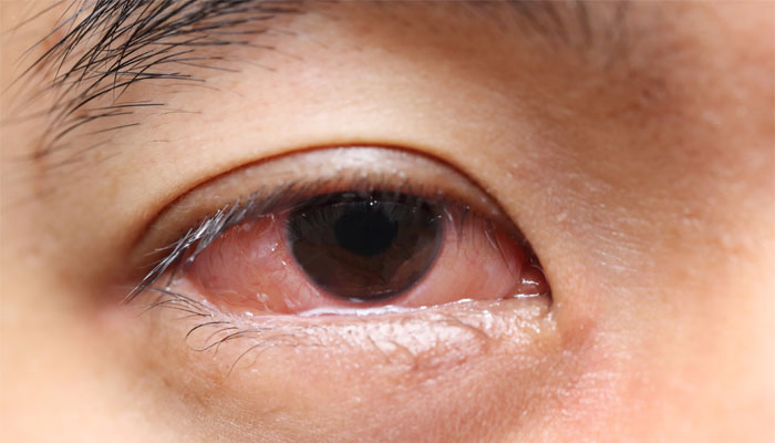 70mm Long Worm Removed From Womans Eye In Kerala