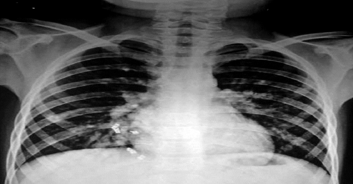 Case Of Plethoric Fields