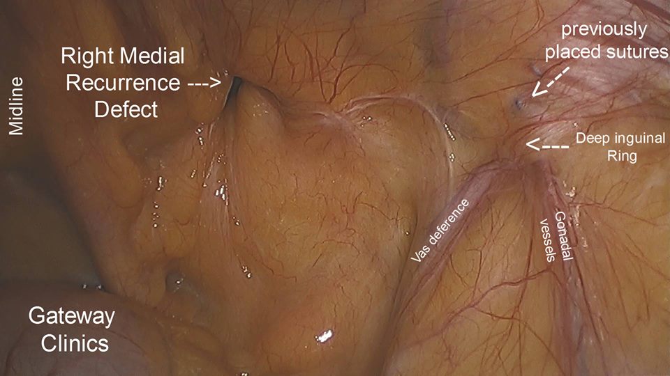 Laparoscopic Right TAPP Repair For Recurrent Inguinal Hernia