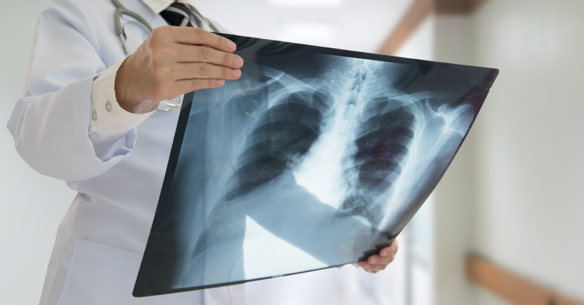 Impact Of Glycemic Status On Radiological Manifestations Of Pulmonary TB