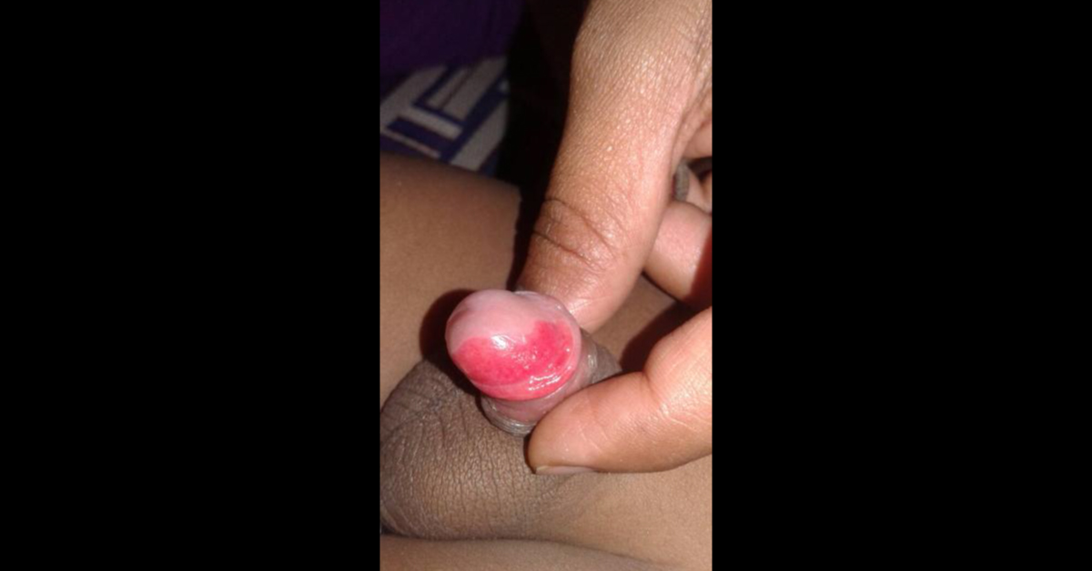 Skin Infection Of The Glans Penis