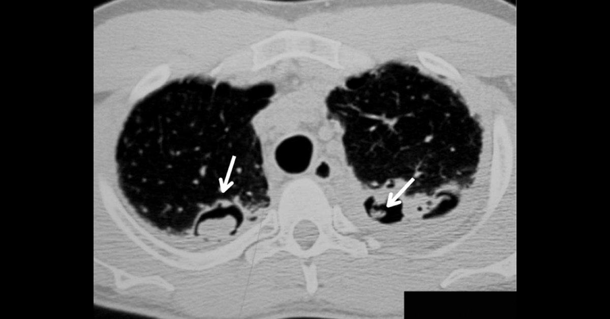 Identify The Complication From The Attached Radiograph