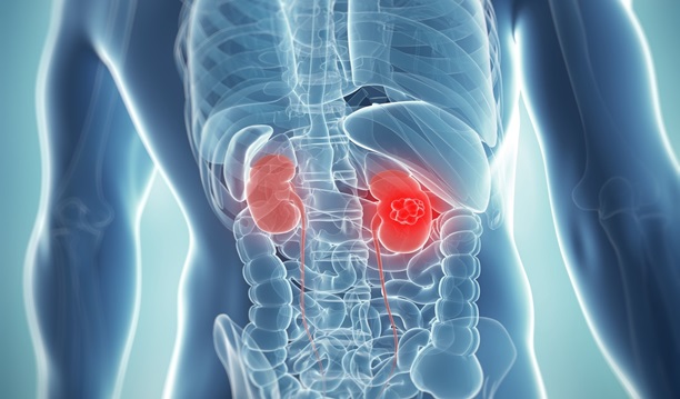 Kidney Cancer Prognosis: An Overview