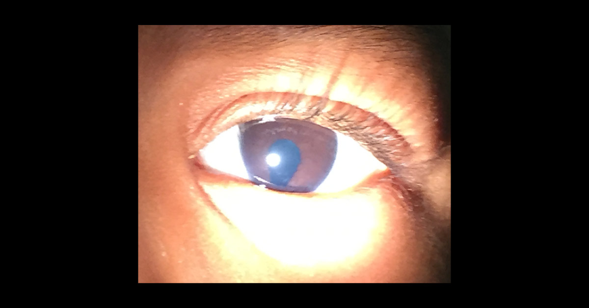 Identify This Ophthalmic Disorder