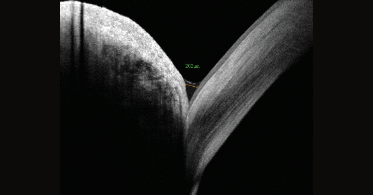 Management Of Meibomian Gland Disease