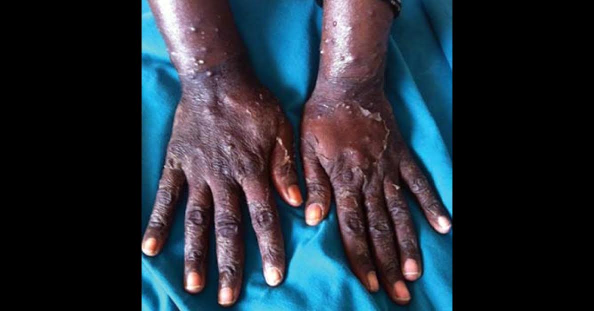 Diagnosis For Papules Over Forearms