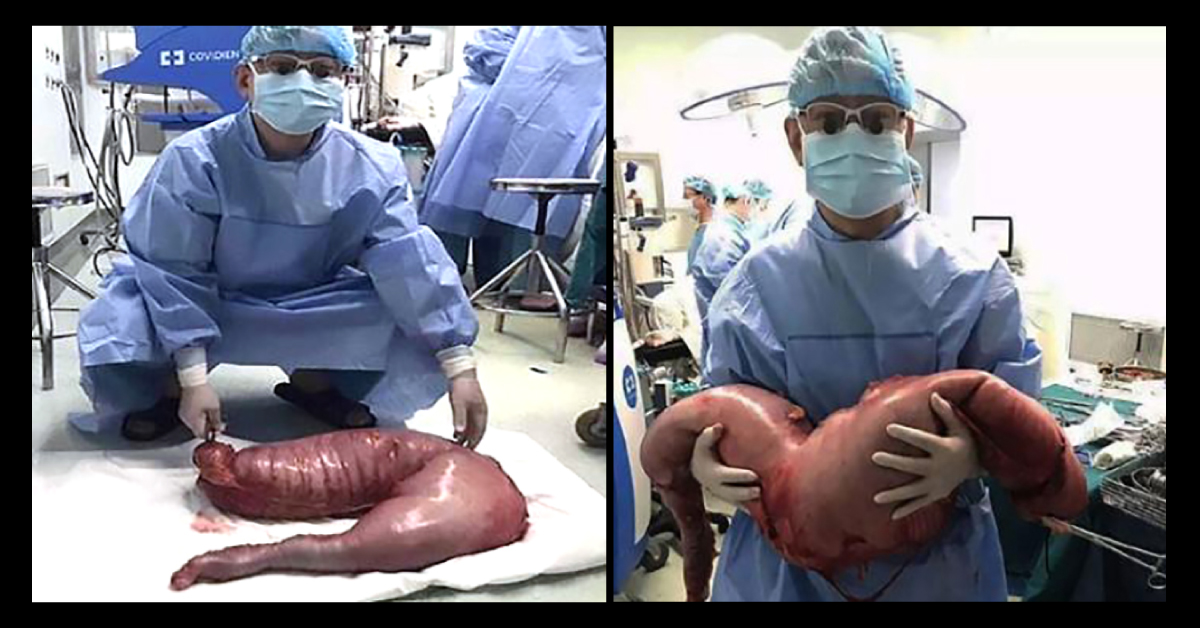 28 Pounds Of Feces Removed From Patient With Hirschsprungs Disease