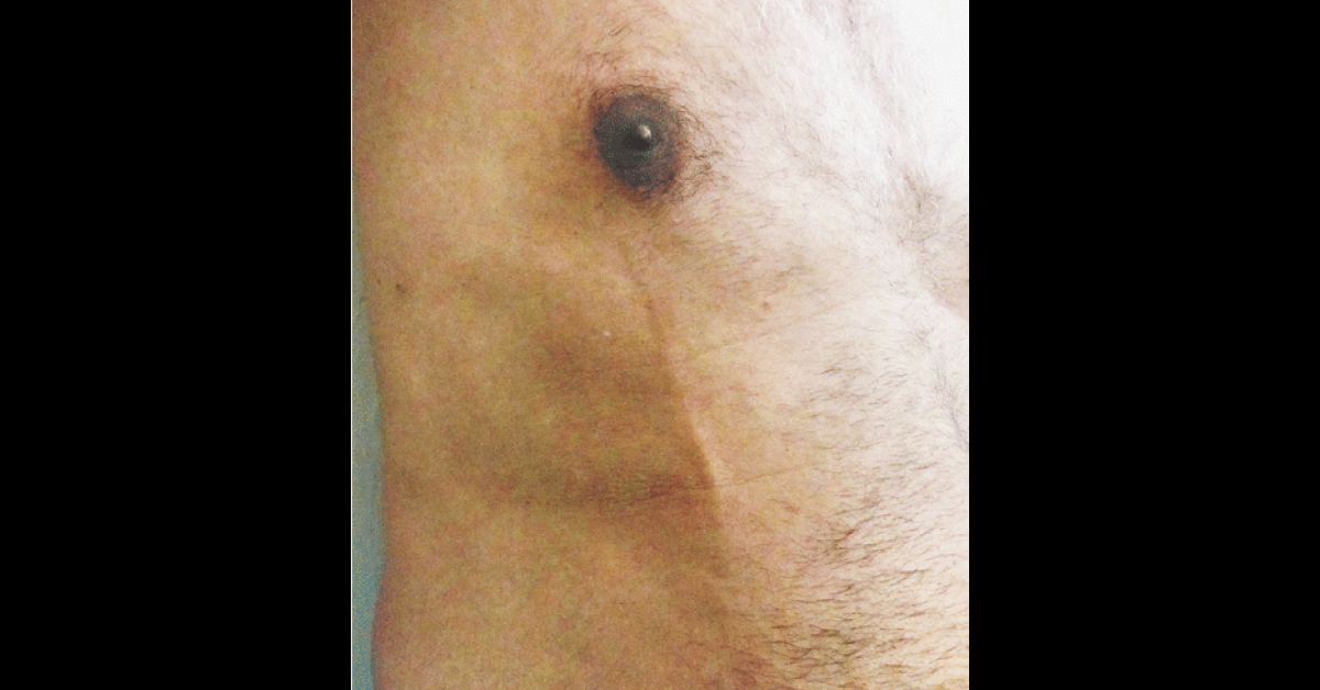 Identify The Reason For Tender Subcutaneous Cord