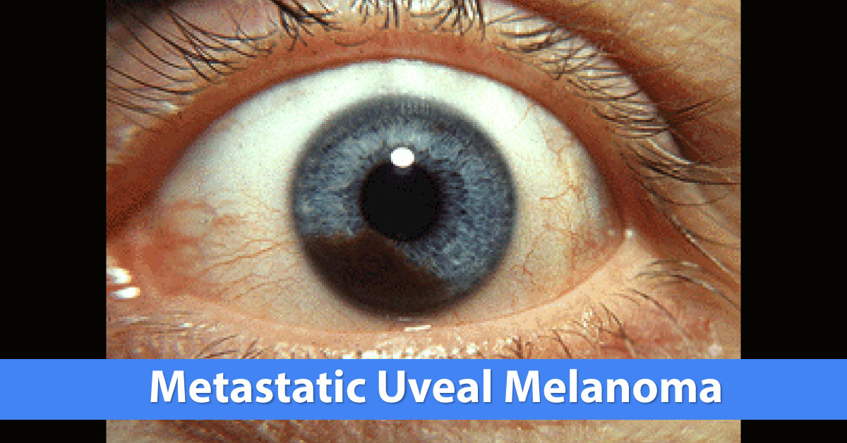 Metastasis Diseases From Uveal Melanoma, Treatment And Future Prospects