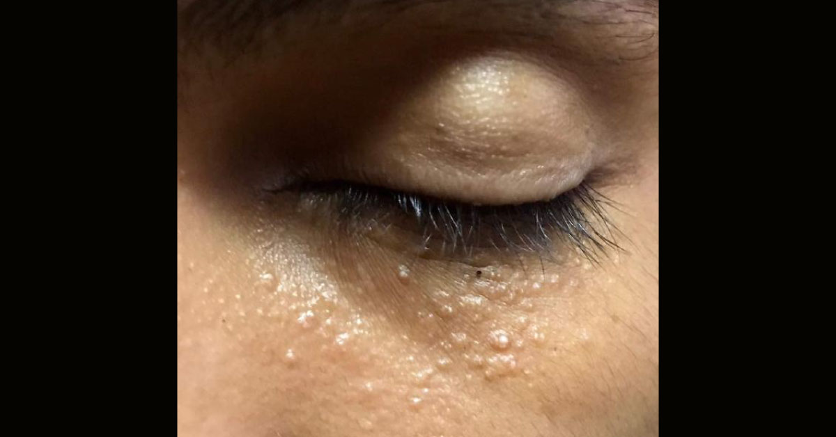 Diagnose The Skin Lesions On Face