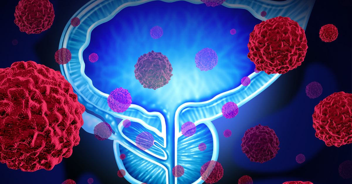 One More New Step In Castrate Sensitive Prostate Cancer, The Latitude Trial