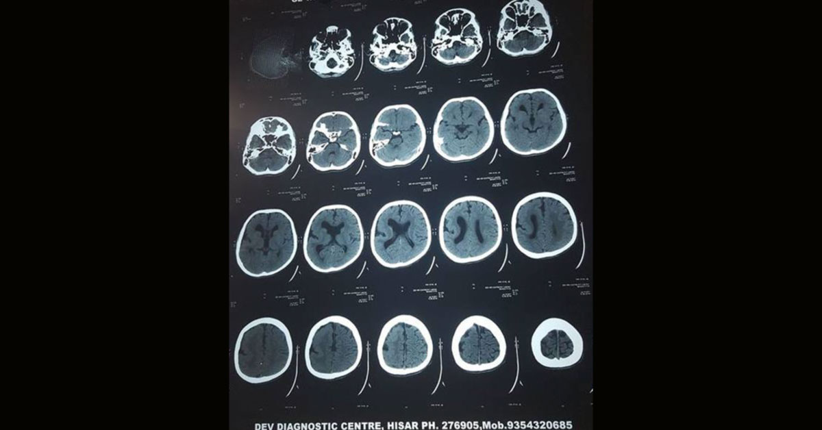 A Case Of Intractable Seizure With CT Of Brain