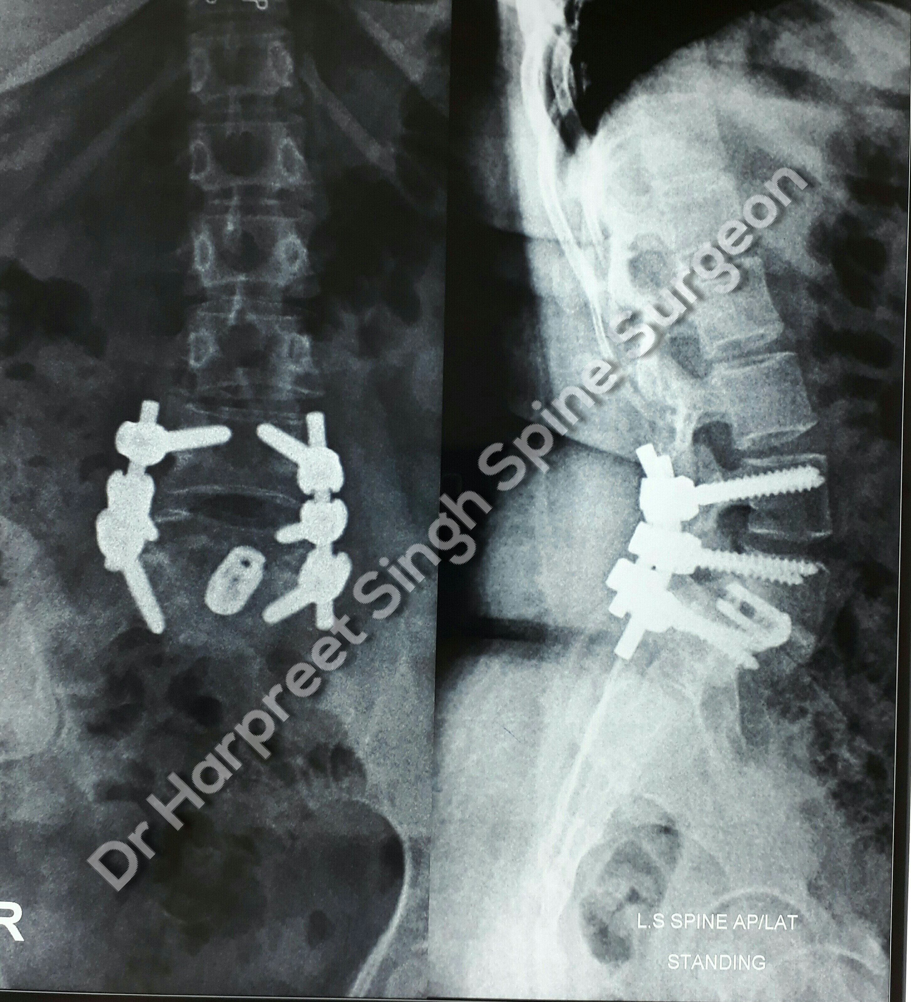 Grade 4 Dysplastic Listhesis Of L5 Over S1 With Unbalanced Pelvis