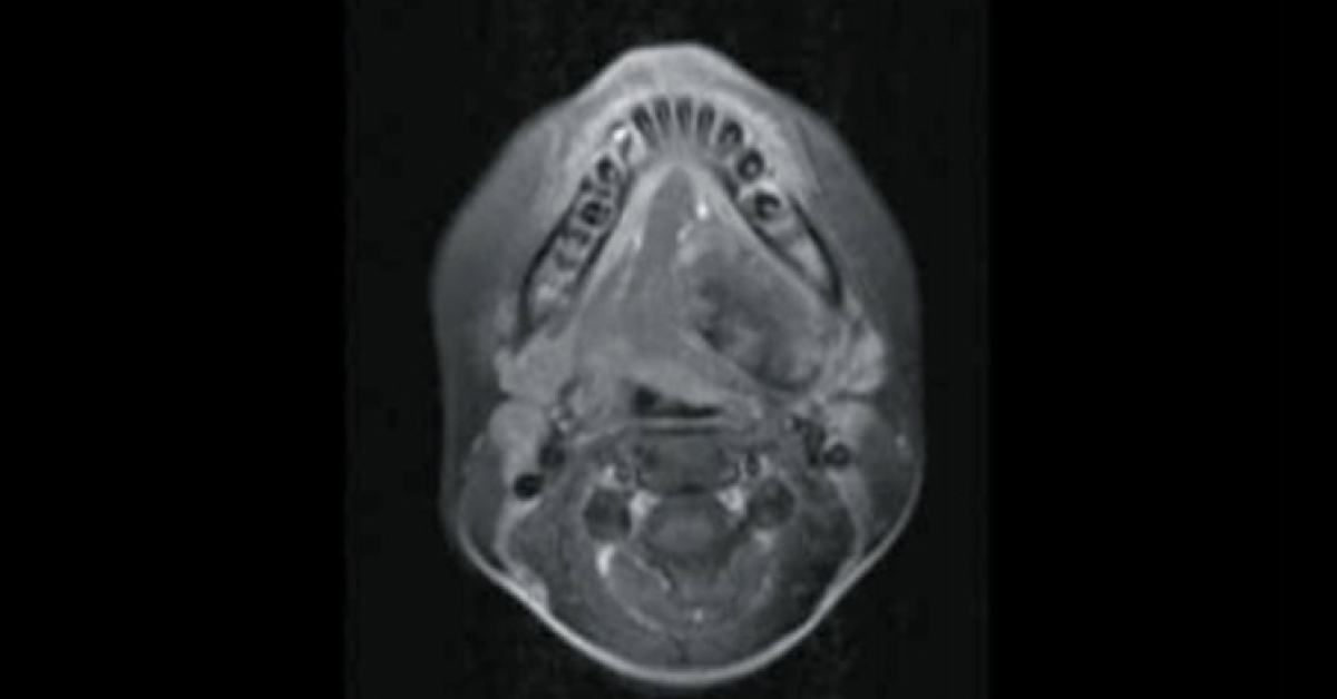 Diagnosis For A Large Oropharyngeal and Upper Neck Mass