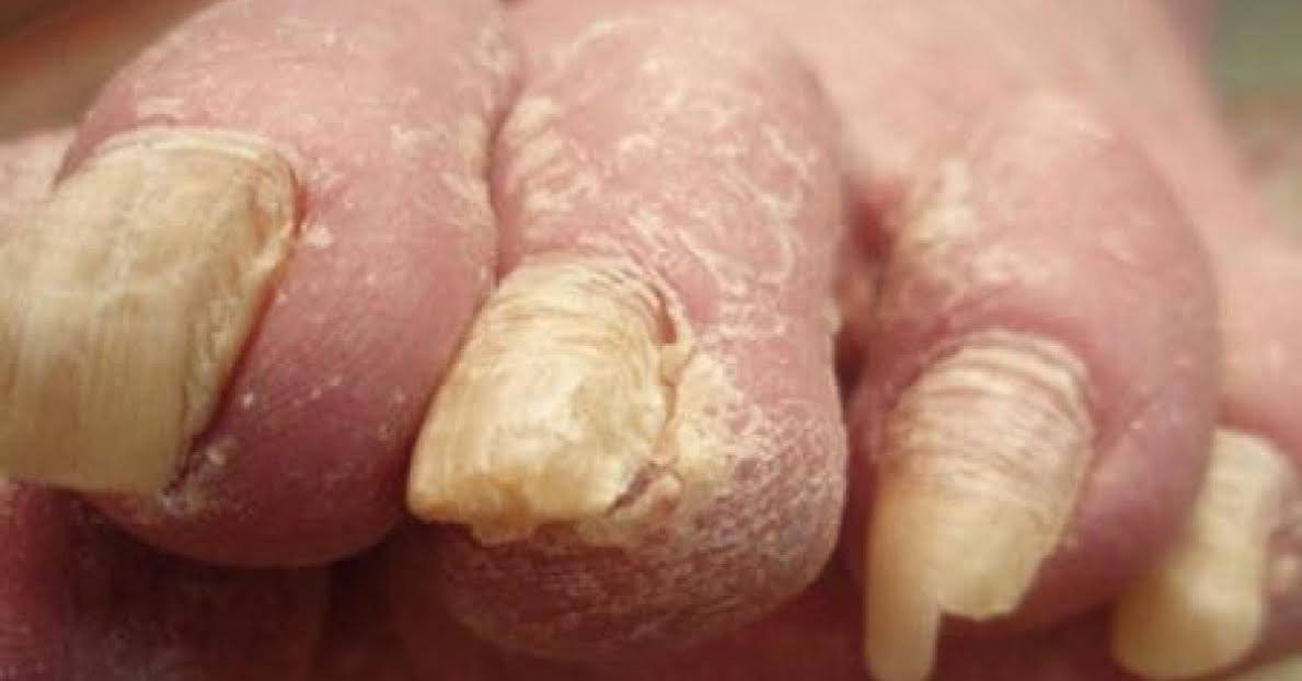 Onychomycosis: British Association of Dermatologists