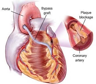 CABG Reduces Mortality Compared To PCI With Drug Eluting Stents
